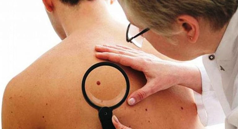 Ilustrasi Kanker Kulit Melanoma (Foto:Harapan Rakyat.com)