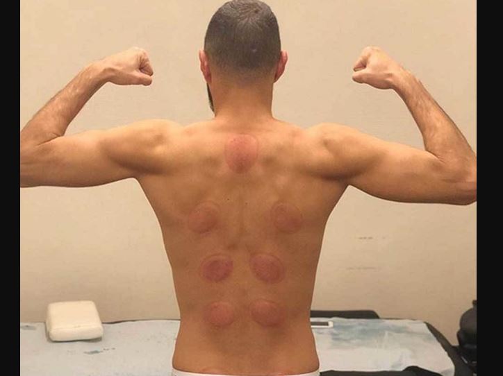 Benzema memamerkan bekas Bekam (Foto: Instagram/@Karimbenzema)
